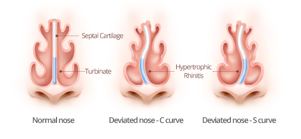 deviated septum图片