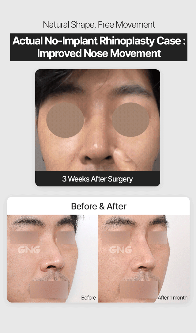 No-implant cartilage injection - GNG Hospital, Plastic surgery, ENT.